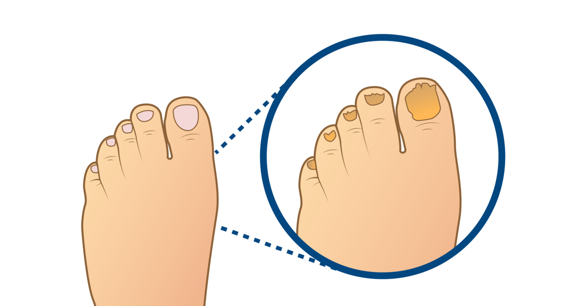 Hassy Sabio sala Estos son los 5 problemas más comunes en las uñas de los pies - CEAPIE