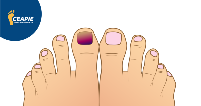 5 problemas más comunes en las uñas de los pies
